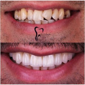 کامپوزیت لیرینگ چیست؟