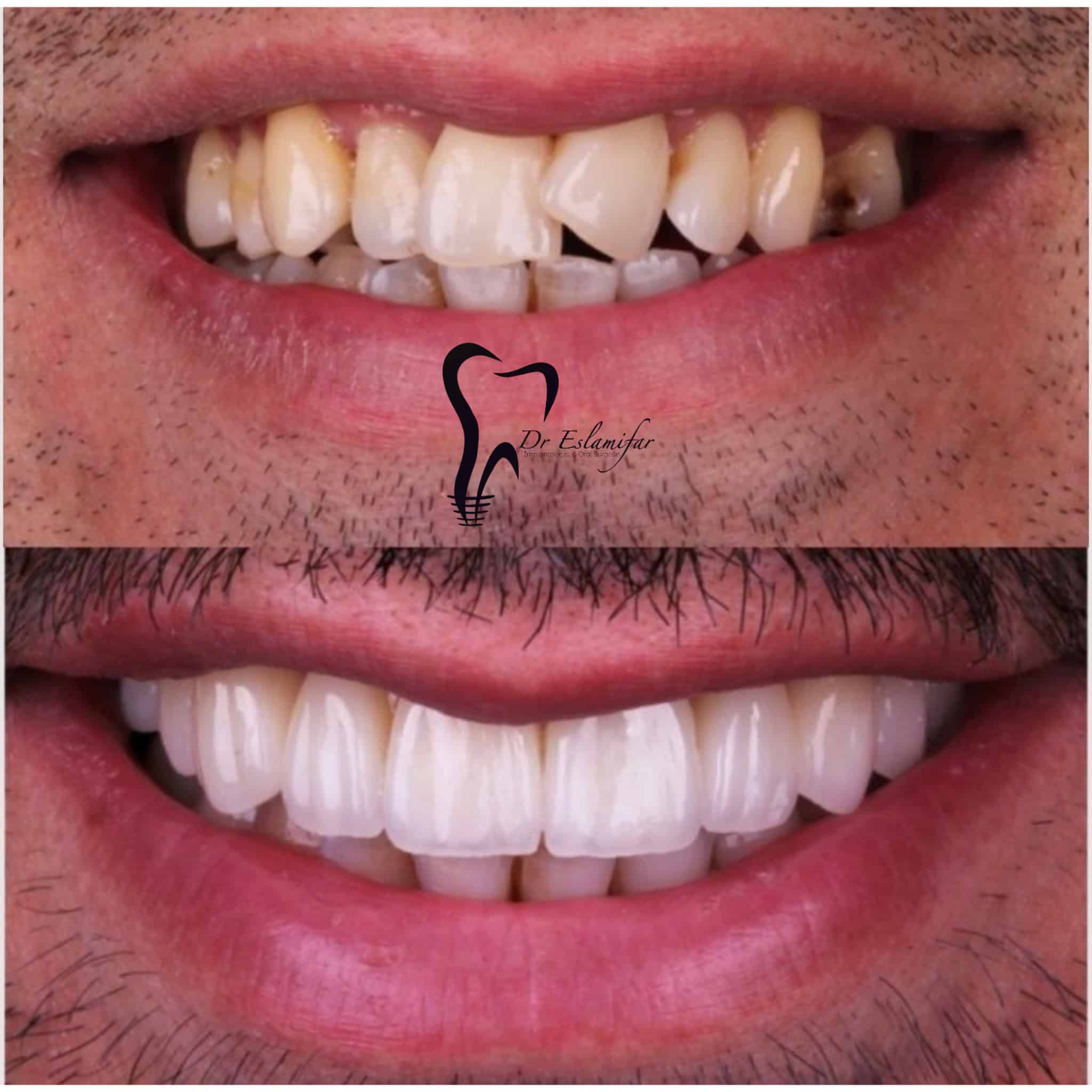 کامپوزیت لیرینگ چیست؟